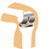 Knee Joint Replacement